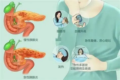 预防胰腺炎 10条忠告 预防胰腺炎 10条忠告