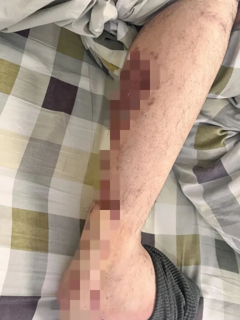 连续喝了一年偏方“中药”36岁男子皮肤溃烂多处癌变 损伤完全不可逆