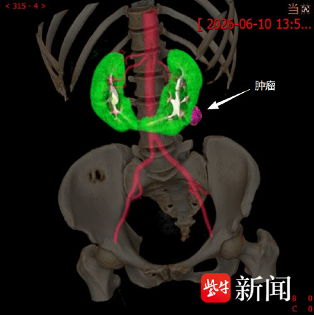 女子双侧肾脏相连似马蹄还长了肿瘤