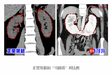 女子双侧肾脏相连似马蹄还长了肿瘤