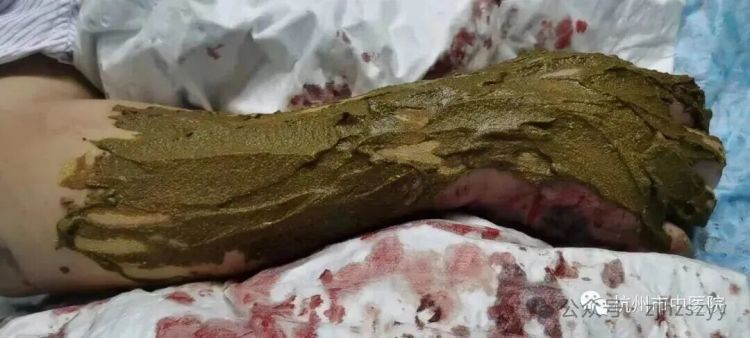 浙江男子在家被毒蛇偷袭咬伤，对视后瞬间晕倒！送医检测尿液已呈酱油色，医生提醒