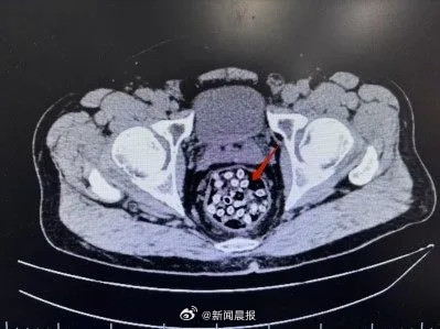 男子吞杨梅核通便致肠梗阻住进了医院,医生:吞杨梅核通便纯属民间谣言 男子吞杨梅核通便致肠梗阻住进了医院,医生:吞杨梅核通便纯属民间谣言