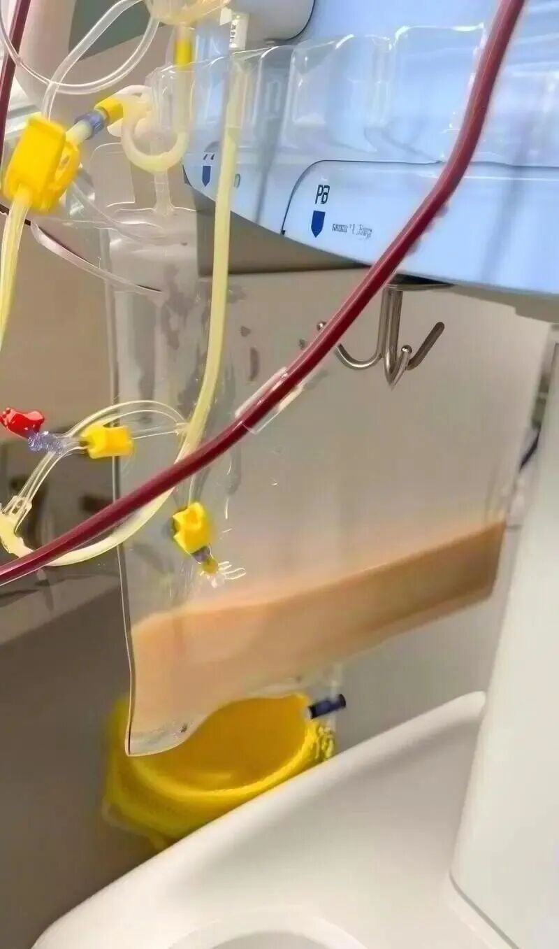 急送ICU!39岁女子一天3杯奶茶,血脂翻118倍,3次换血!身体器官被自己“消化” 急送ICU!39岁女子一天3杯奶茶,血脂翻118倍,3次换血!身体器官被自己“消化”