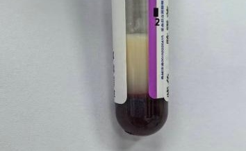 急送ICU!39岁女子一天3杯奶茶,血脂翻118倍,3次换血!身体器官被自己“消化” 急送ICU!39岁女子一天3杯奶茶,血脂翻118倍,3次换血!身体器官被自己“消化”