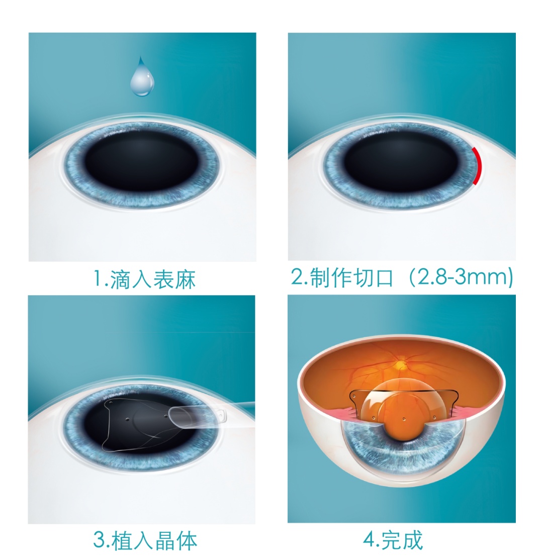 那些用晶体植入治疗近视的人,后来怎样了? 那些用晶体植入治疗近视的人,后来怎样了?