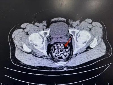 一男子半筐杨梅下肚,肛门剧痛直冒冷汗!肠道密密麻麻全是它…医生提醒→ 一男子半筐杨梅下肚,肛门剧痛直冒冷汗!肠道密密麻麻全是它…医生提醒→