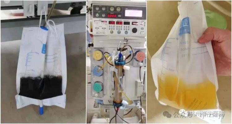 浙江男子在家被毒蛇偷袭咬伤，对视后瞬间晕倒！送医检测尿液已呈酱油色，医生提醒