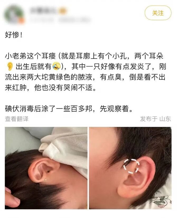 耳朵上的这个小洞,千万别挤 耳朵上的这个小洞,千万别挤
