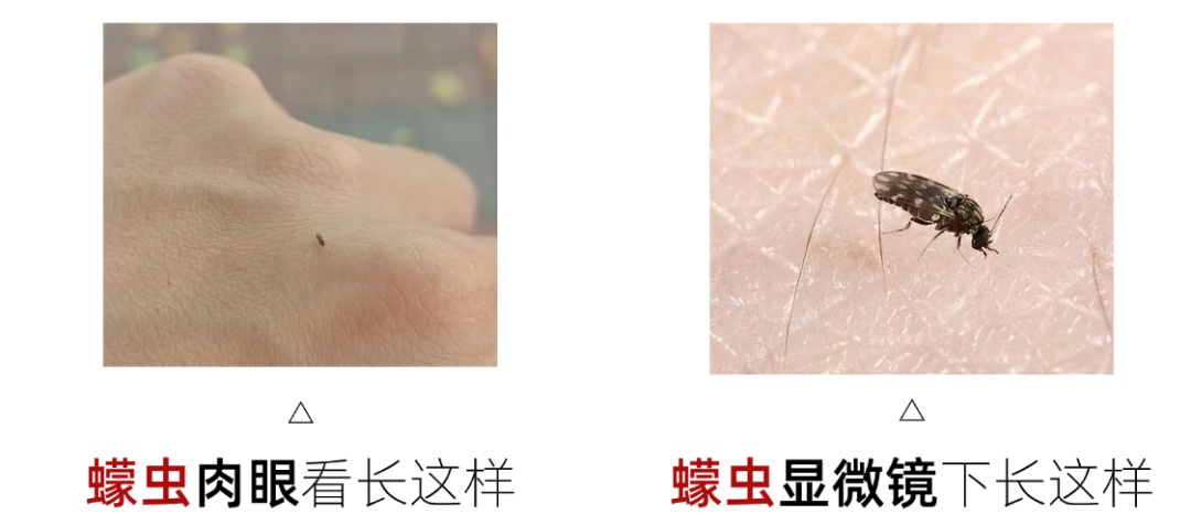 比蚊子更小,毒性更大!这种虫子进入活跃期,被咬后奇痒无比!不少深圳人中招...... 比蚊子更小,毒性更大!这种虫子进入活跃期,被咬后奇痒无比!不少深圳人中招......