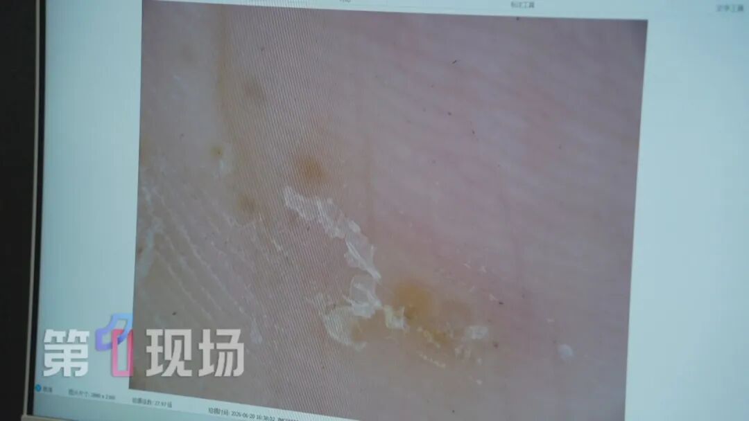 痒痒痒痒痒!近期高发,这些虫子进入活跃期!不少深圳人中招...... 痒痒痒痒痒!近期高发,这些虫子进入活跃期!不少深圳人中招......