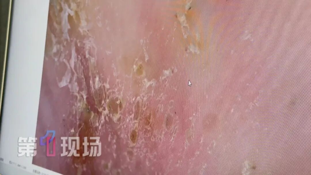 痒痒痒痒痒!近期高发,这些虫子进入活跃期!不少深圳人中招...... 痒痒痒痒痒!近期高发,这些虫子进入活跃期!不少深圳人中招......