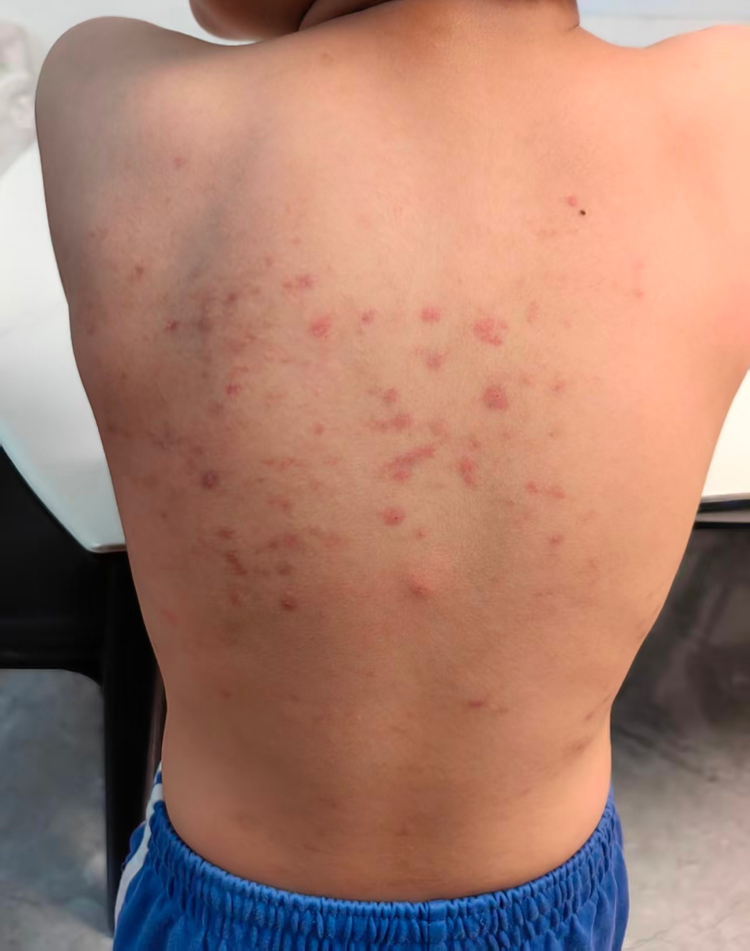 痒痒痒痒痒!近期高发,这些虫子进入活跃期!不少深圳人中招...... 痒痒痒痒痒!近期高发,这些虫子进入活跃期!不少深圳人中招......