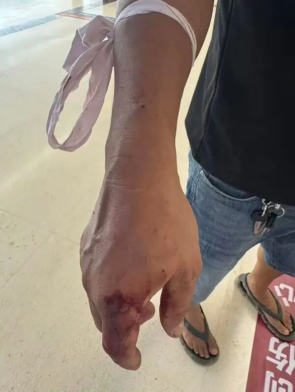 男子被毒蛇咬伤，徒手将蛇活捉到医院就医！福州多地也出现了！医生提醒