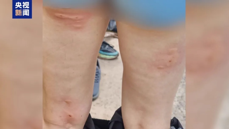 膝盖留下狰狞疤痕 全身16处被马蜂蜇伤 致敬这些缉毒英雄 膝盖留下狰狞疤痕 全身16处被马蜂蜇伤 致敬这些缉毒英雄