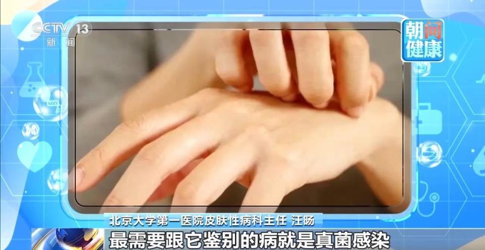 夏天高频发作汗疱疹到底是什么病如何根治