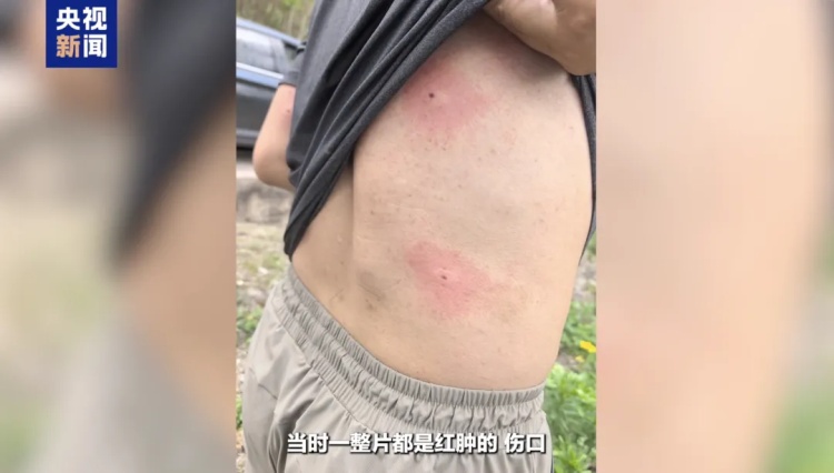 膝盖留下狰狞疤痕 全身16处被马蜂蜇伤 致敬这些缉毒英雄 膝盖留下狰狞疤痕 全身16处被马蜂蜇伤 致敬这些缉毒英雄