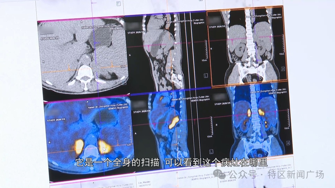 腹痛9个月，厦门一男子染上“欧美真菌病”！病因出人意料……