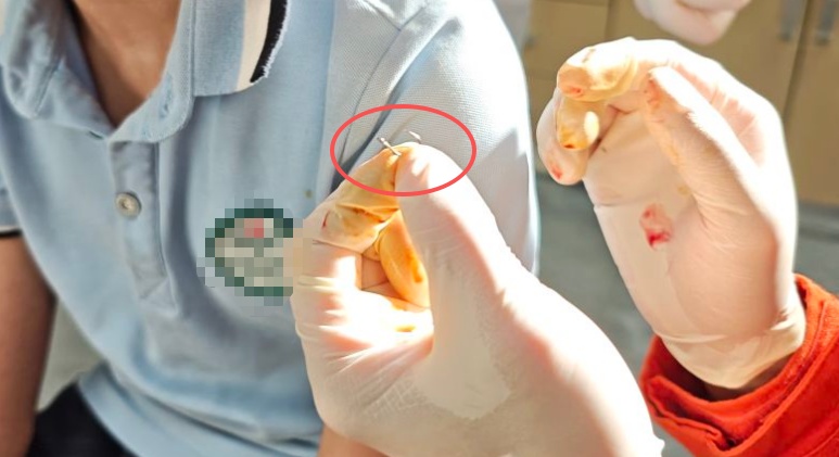 男孩被鱼钩“打耳洞”,钓鱼千万要小心 男孩被鱼钩“打耳洞”,钓鱼千万要小心
