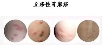 比蚊子更小，更毒！重庆人注意，这种虫子进入活跃期→