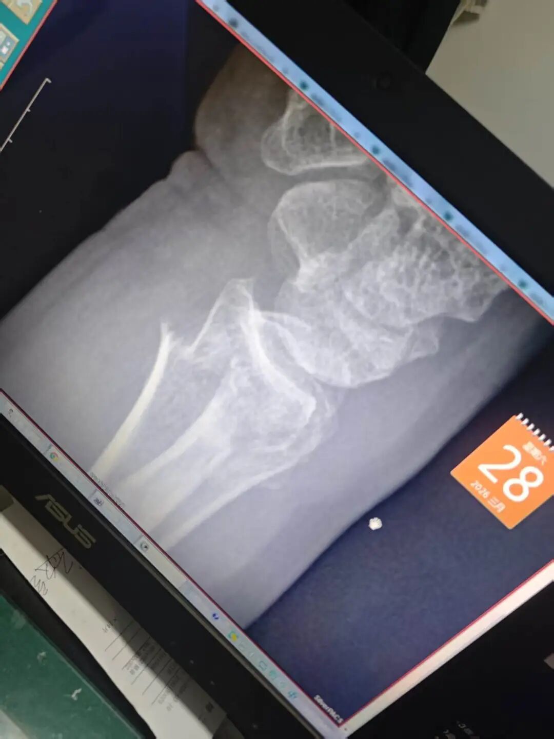 扬州一大型犬与柴犬打闹，扑倒老人致手腕骨折，大型犬主人：正走法律程序，不会拒赔