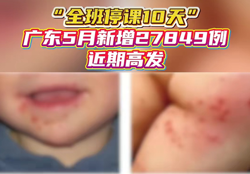 手足口病高发!别只盯着疱疹,真正危险的是这些信号→ 手足口病高发!别只盯着疱疹,真正危险的是这些信号→