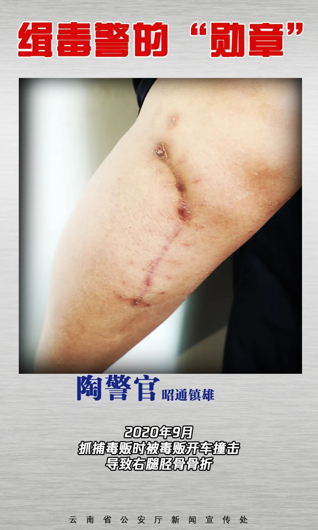 云南缉毒警的“勋章”，是满身伤疤→