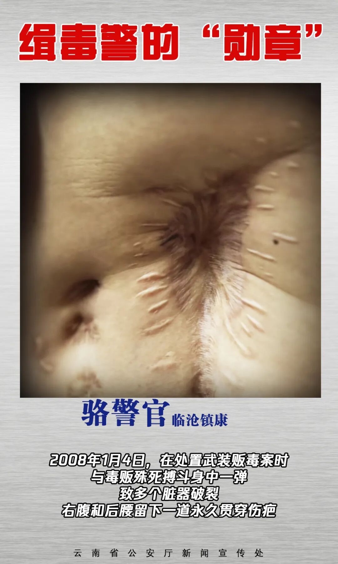 触目惊心！缉毒警的伤疤，摘不掉的“勋章”！