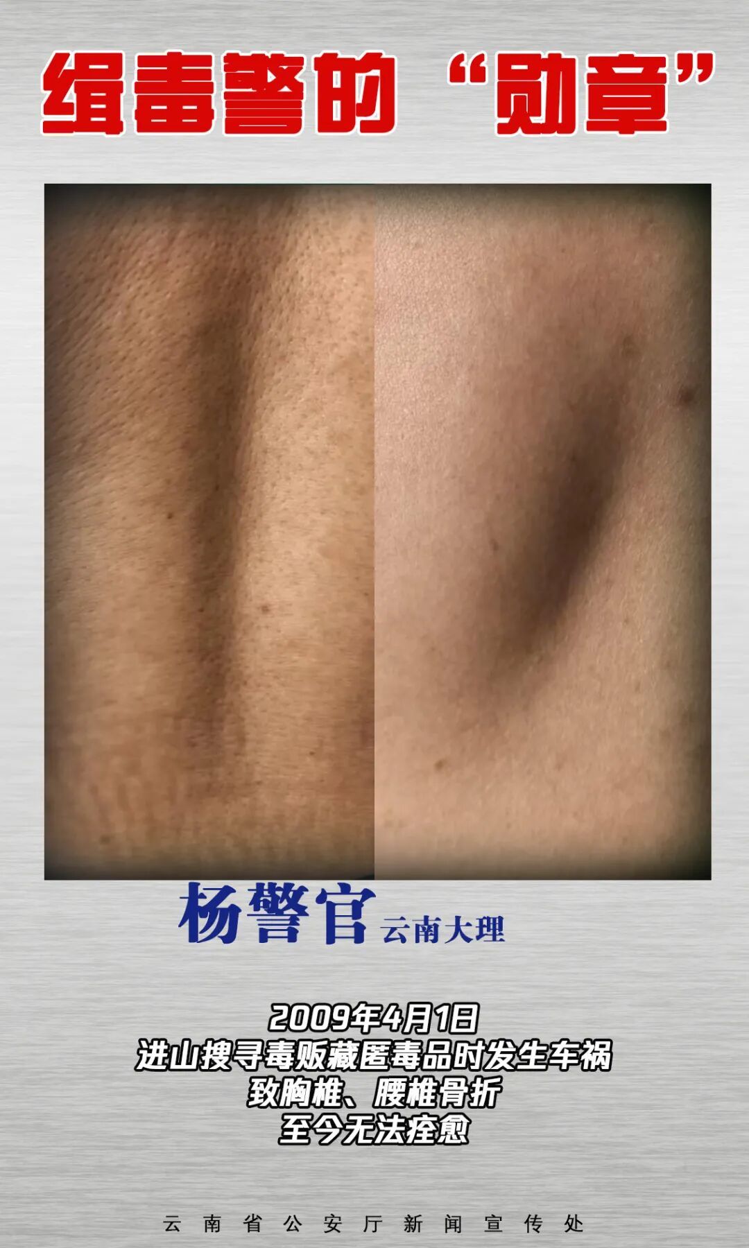 云南缉毒警的“勋章”，是满身伤疤→