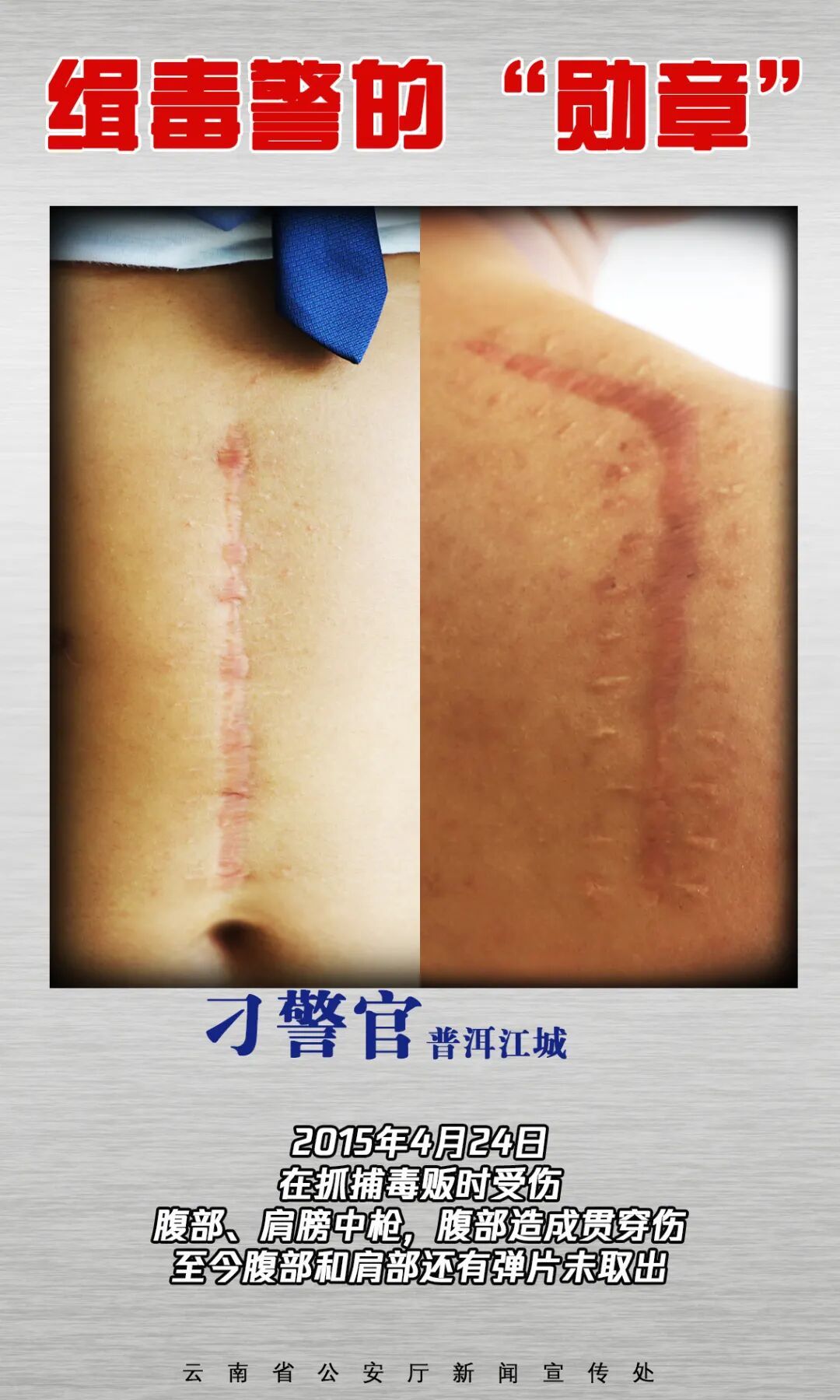 云南缉毒警的“勋章”，是满身伤疤→