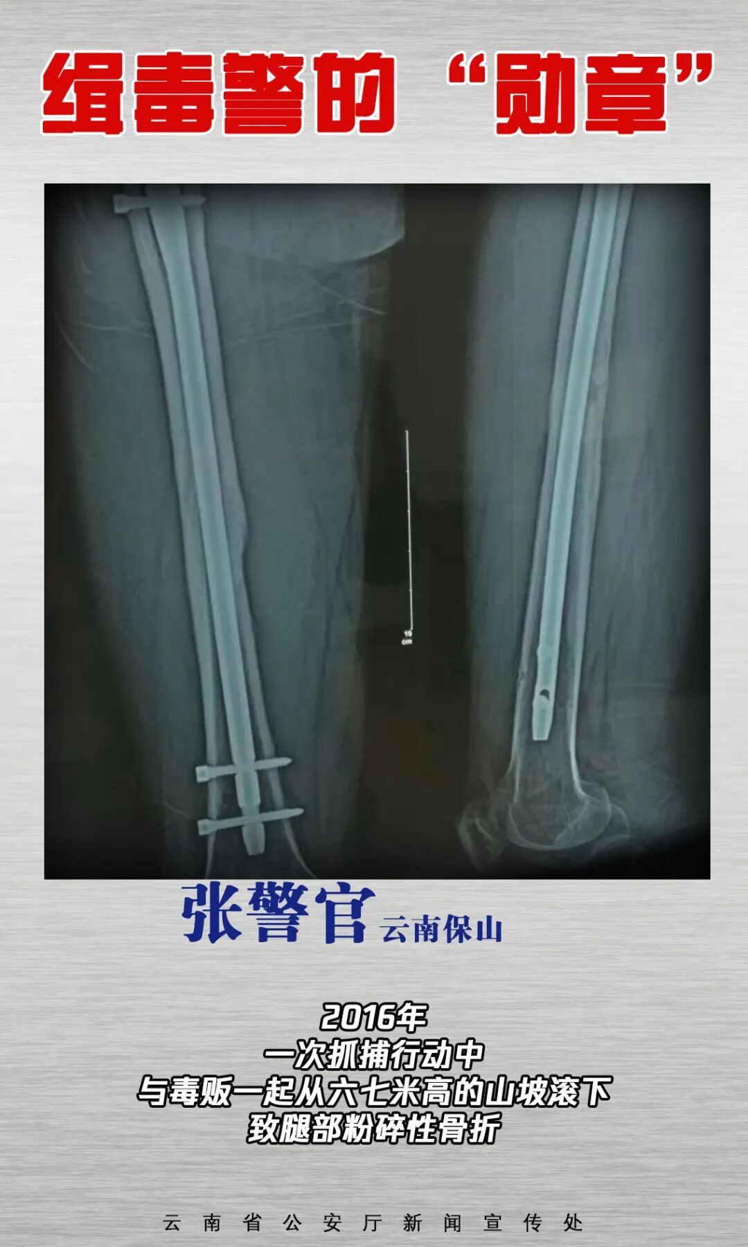 触目惊心！缉毒警的伤疤，摘不掉的“勋章”！