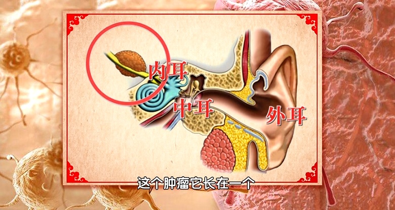 大脑有疾，耳朵先知，听到这种声音，当心脑梗已经找上门