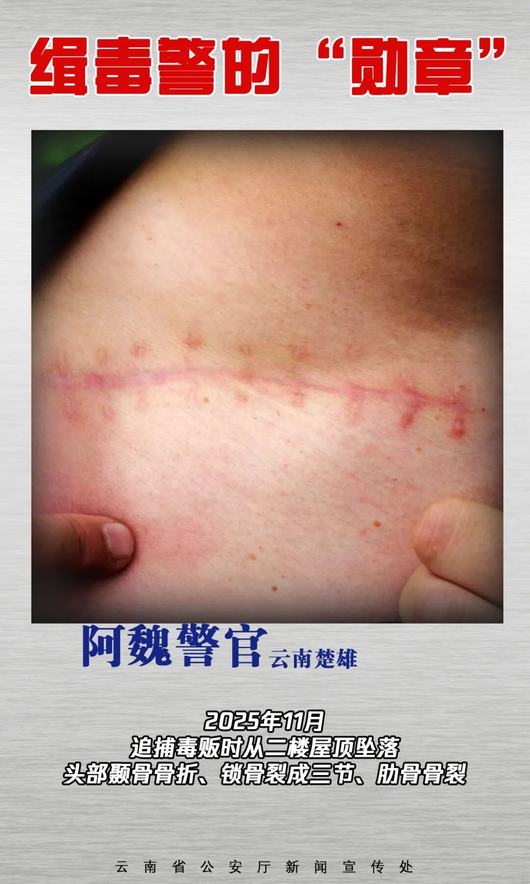 触目惊心！缉毒警的伤疤，摘不掉的“勋章”！