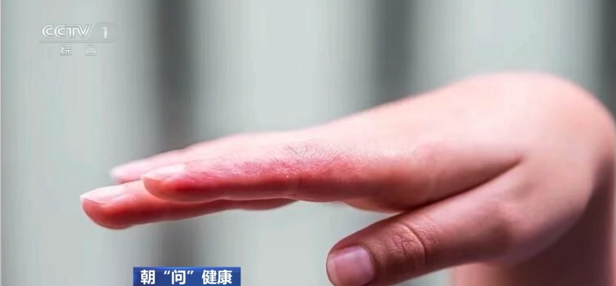 一到夏天手上就起小水疱？处理不当或诱发全身湿疹！这些偏方千万别信