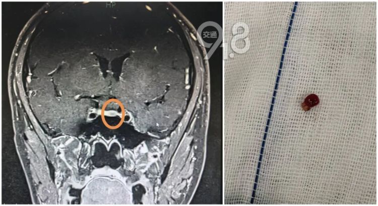 杭州32岁健身小伙以为是增肌 结果是胸部“发育” 医生：病根藏在大脑里