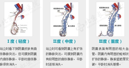 备孕两年无果，28岁杭州男子傻眼：这里竟藏了一窝“蚯蚓”！医生：千万别小看了