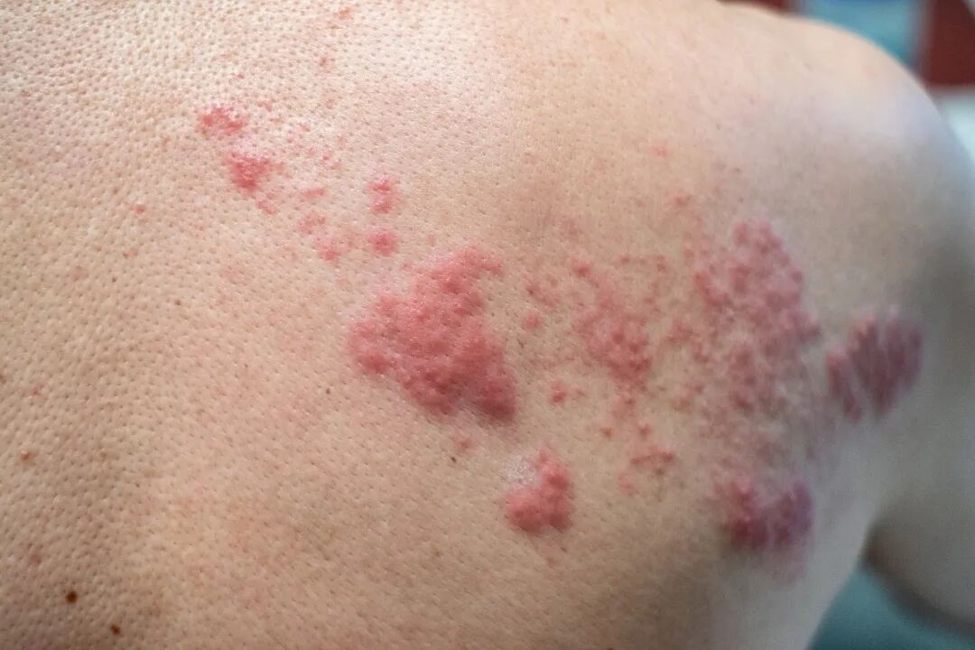 以为是湿疹，结果一查竟是癌！皮肤出现3种变化，千万别视而不见