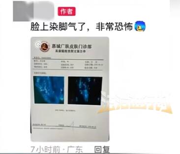 男子健身后脸上长“脚气”，直呼“太恐怖”！有网友曾中招…