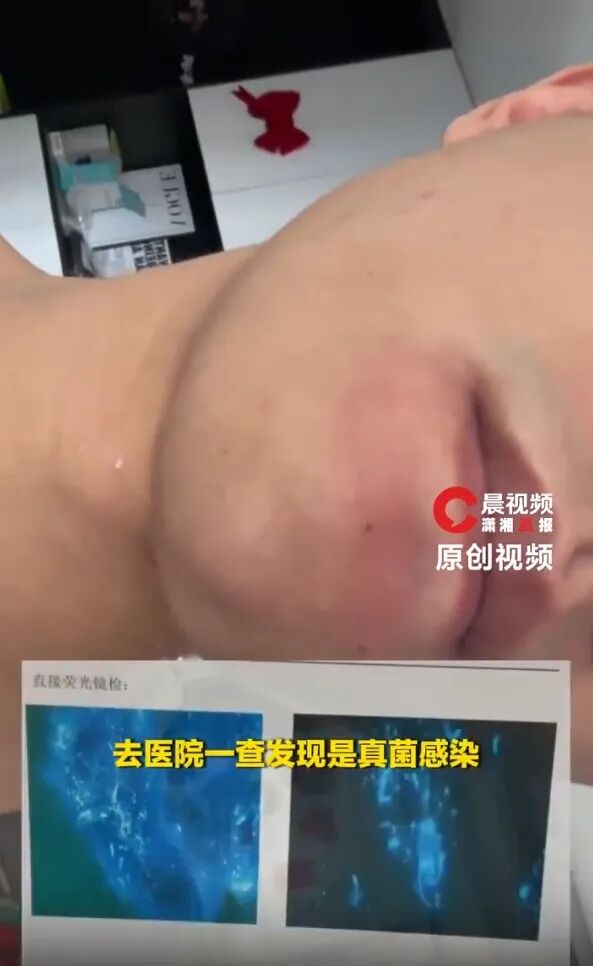 男子健身后用手擦汗，脸上竟感染"脚气"，直呼太恐怖！网友：我也是…