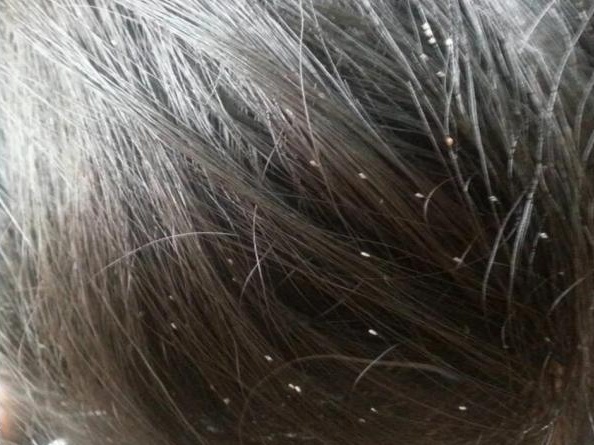 母子俩头皮发痒、头屑多，皮肤镜下一照，头发里藏着密密麻麻的…