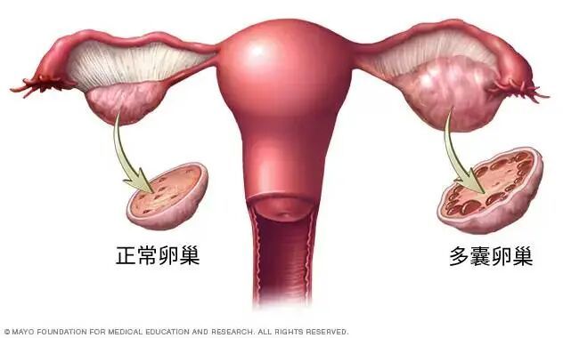 终于改名!这个病困扰全球1.7亿女性,却被“叫错”90年 终于改名!这个病困扰全球1.7亿女性,却被“叫错”90年