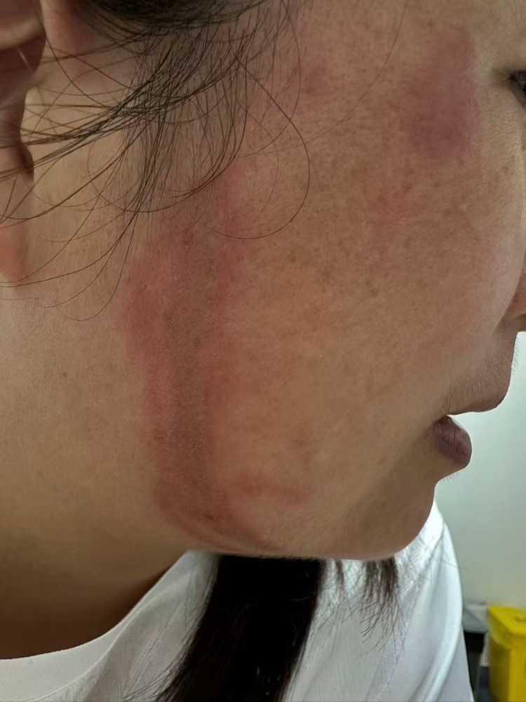 多人中招!一觉醒来脖子烂出红条,像被鞭子抽过……医生提醒:千万别拍 多人中招!一觉醒来脖子烂出红条,像被鞭子抽过……医生提醒:千万别拍