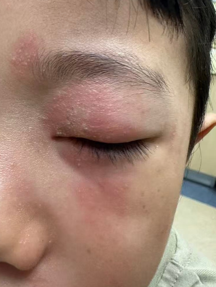 多人中招!一觉醒来脖子烂出红条,像被鞭子抽过……医生提醒:千万别拍 多人中招!一觉醒来脖子烂出红条,像被鞭子抽过……医生提醒:千万别拍