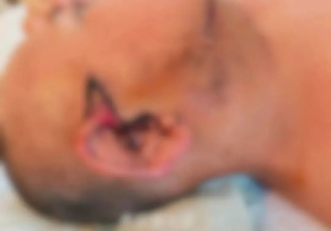 男子遭意外耳朵被扯掉,离体20小时错过再植黄金时限,医生将断耳“寄养”在他脚背上 男子遭意外耳朵被扯掉,离体20小时错过再植黄金时限,医生将断耳“寄养”在他脚背上