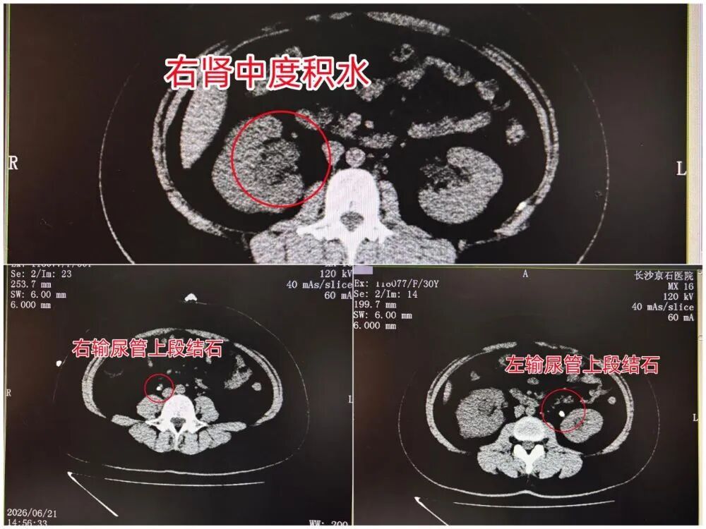 女子患肾结石不痛以为好了，2个月后双肾却积水“亮红灯”