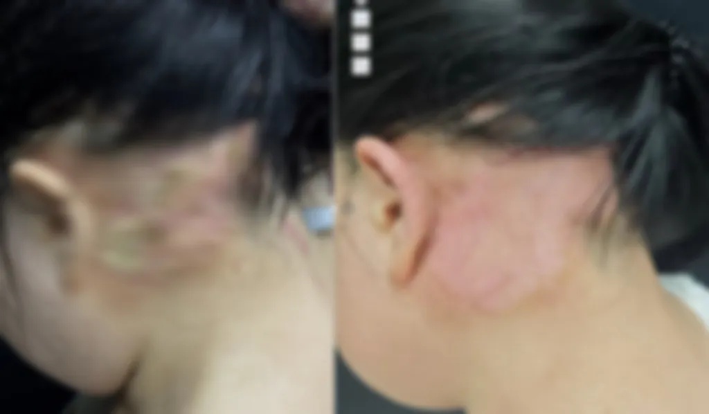 广东28岁女子一出生就患怪病,半边身体长满“苔藓”每次长高发病越狠 广东28岁女子一出生就患怪病,半边身体长满“苔藓”每次长高发病越狠