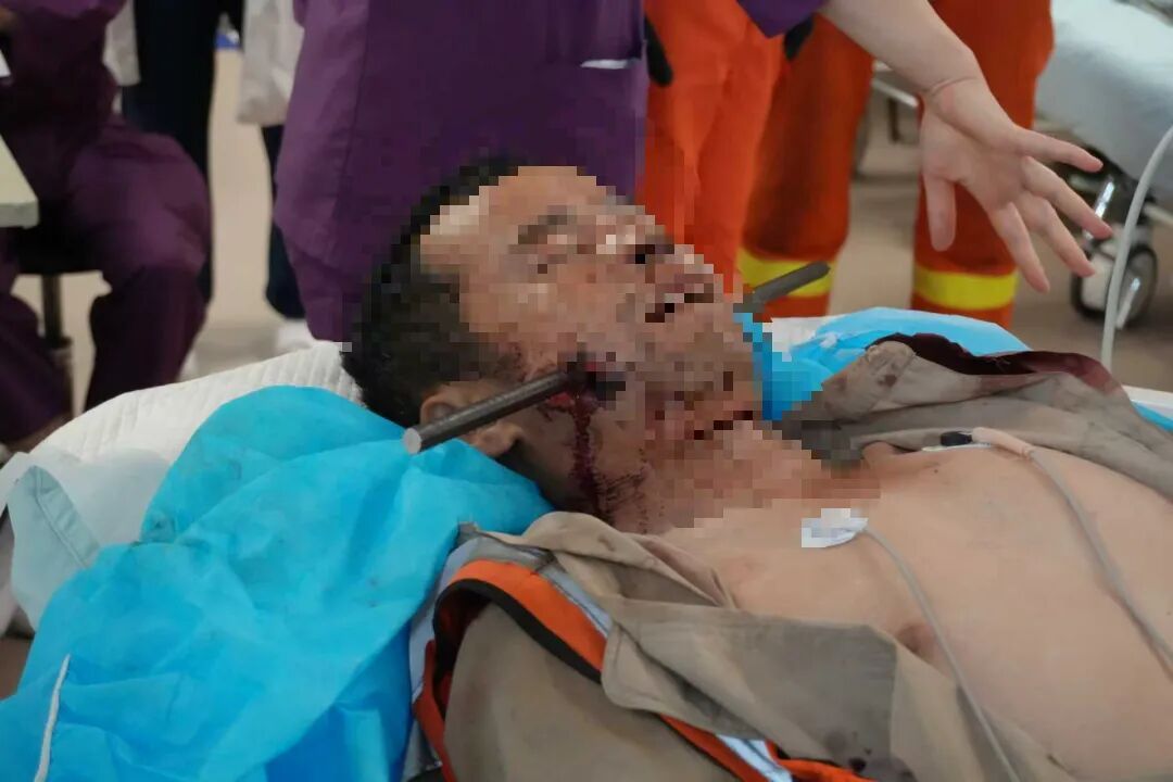 惊险!男子面部遭钢筋贯穿,北京消防紧急切断…… 惊险!男子面部遭钢筋贯穿,北京消防紧急切断……
