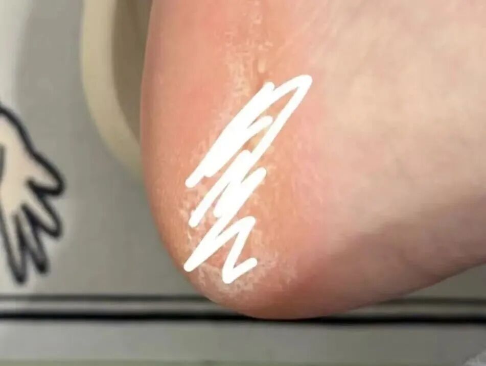 下雨天特别流行！很多人爱穿洞洞鞋，医生提醒→