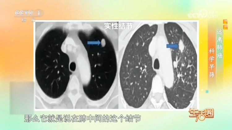 体检查出结节、息肉?先别慌!赶快对照这些关键指标自查→ 体检查出结节、息肉?先别慌!赶快对照这些关键指标自查→