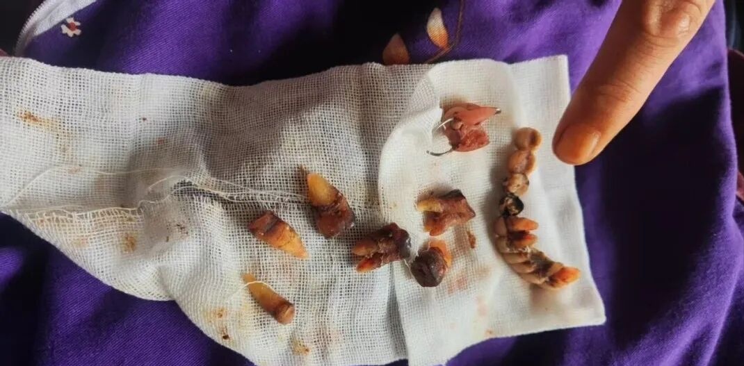 63岁心梗老人仅一颗牙疼就医,被拔牙12颗再种10颗!当地卫健局已介入 63岁心梗老人仅一颗牙疼就医,被拔牙12颗再种10颗!当地卫健局已介入