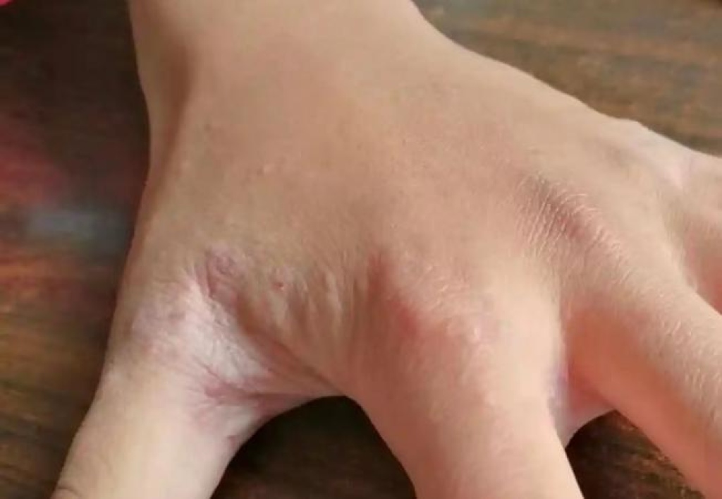 一家五口感染疥疮,专家提醒:这种痒夏季高发且易传染 一家五口感染疥疮,专家提醒:这种痒夏季高发且易传染